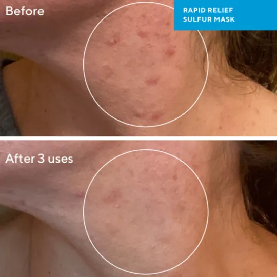 Murad Rapid Relief Sulfur Mask 75 ml