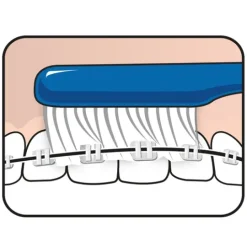 TePe Implant Orthodontic 1 st
