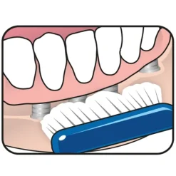 TePe Implant Orthodontic 1 st