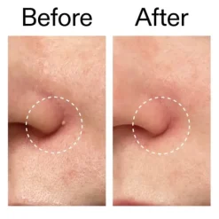The INKEY List Hydrocolloid Invisible Pimple Patches 22 st
